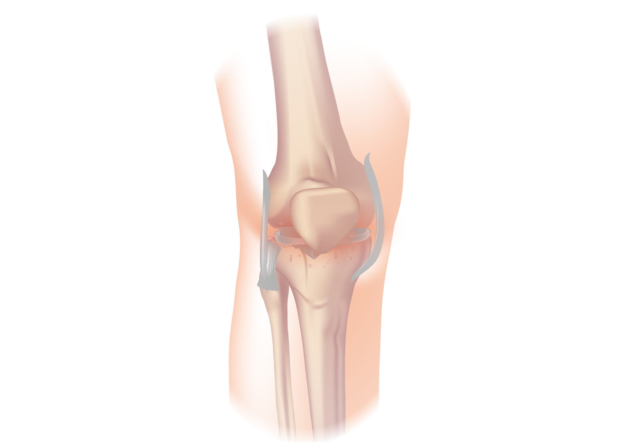 Illustration of osteoarthritis in the knee joint