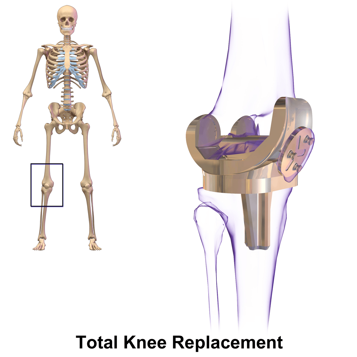 Illustration of the knee joint and components of a knee replacement