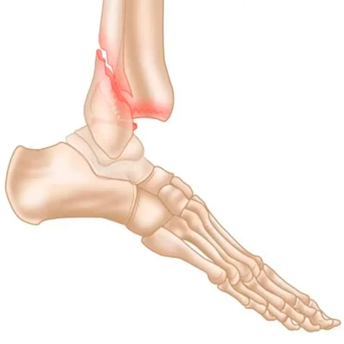 Ankle Joint Fractures | كسور مفصل الكاحل