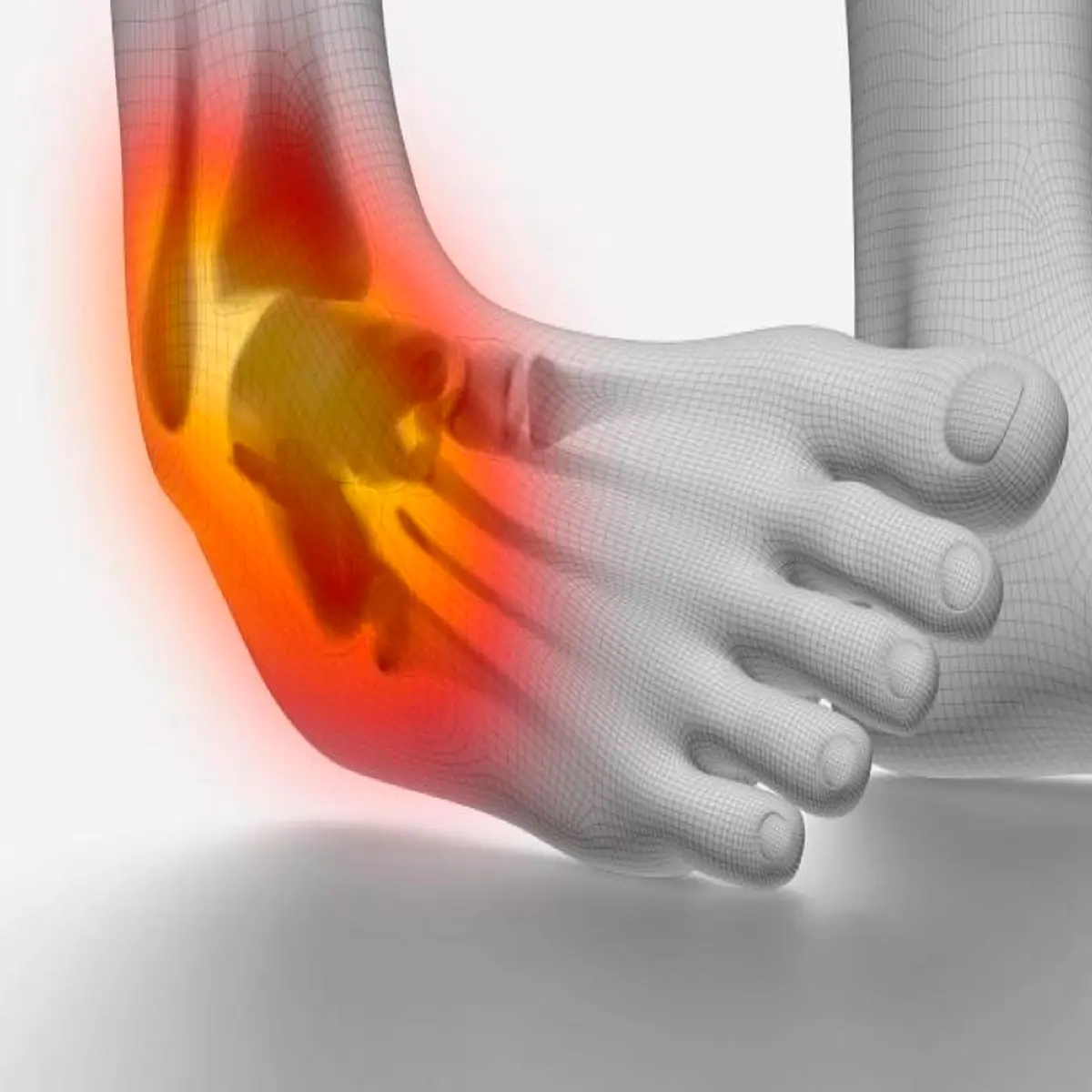 Ankle sprain and ligament tear | التواء كاحل القدم وتمزق الاربطة