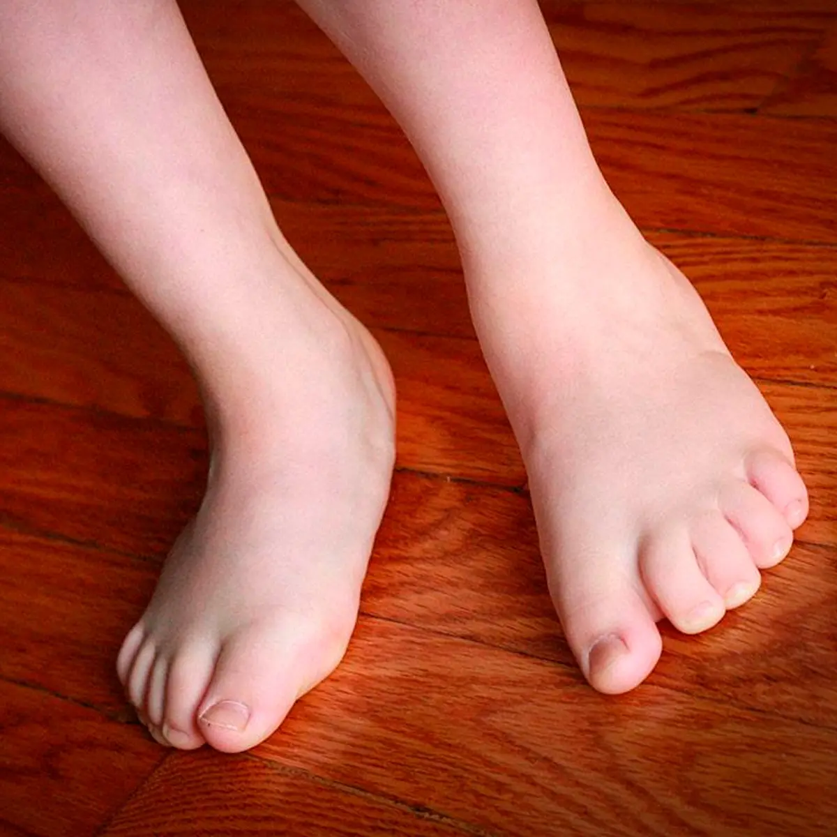 Flat Feet in Children | تبسط القدم لدى الأطفال