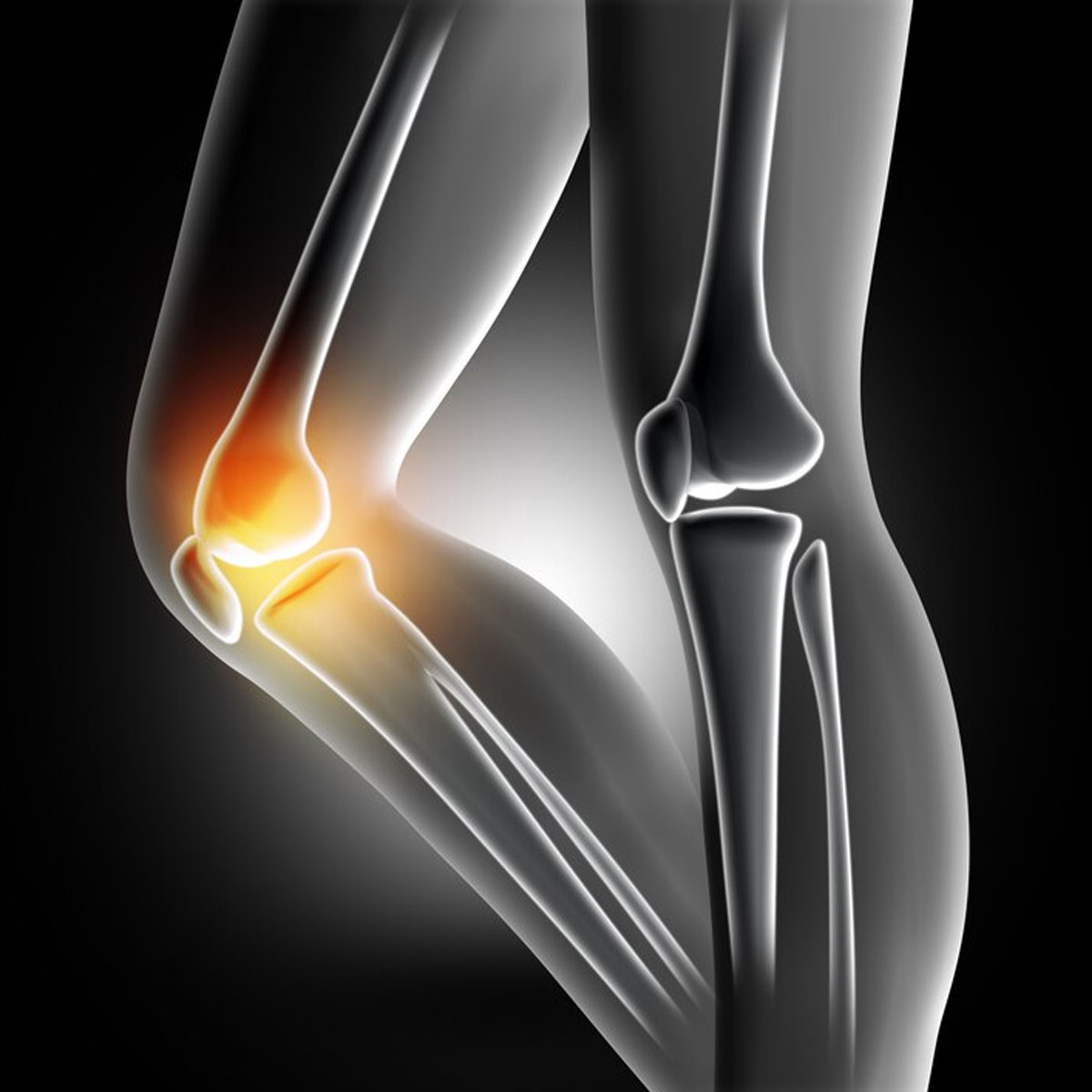 التمزق الغضروفي للركبة | Meniscal Tear in the Knee