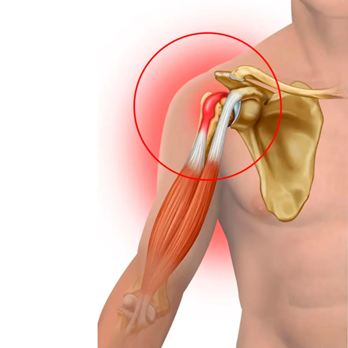 Tendonitis of the Bicipital Head | التهاب الأوتار ذات الرأسين