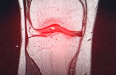 خشونة العظام