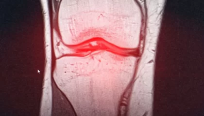 خشونة العظام