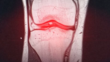 خشونة العظام